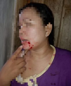 Diduga Jadi Korban Pengeroyokan, Damai Pitri Laporkan Hamidah Cs ke Mapolres Bungo