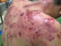 Diduga Dianiaya Oknum TNI di Makodim 0420/Sarko, Warga Merangin Alami Luka Lebam dan Jalani Perawatan Intensif